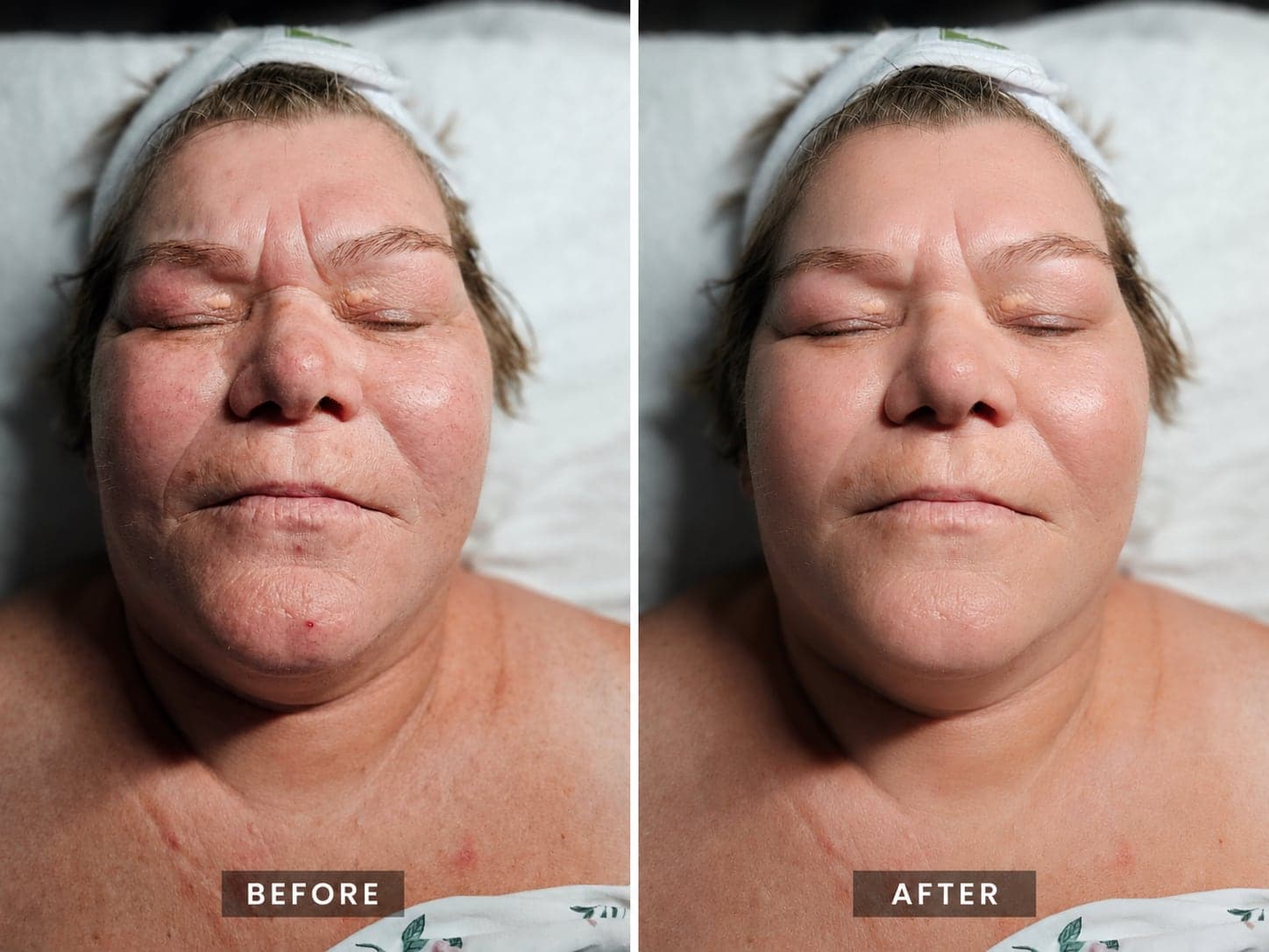 Before and after a facial at Harav Salon & Spa in Winnipeg — smoother, calmer skin texture